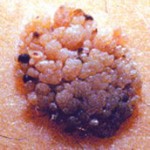 Seborrhoeic Wart Removal £180 | Learn more about warts