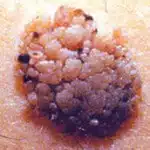 Seborrhoeic Wart that can be shaved at Thames Valley Surgical Services