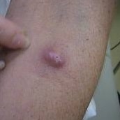 I have a large sebaceous cyst - should I be worried? - The Dermatology  Specialists