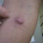 image of an epidermoid (sebaceous) cyst that can be removed by Thames Valley Surgical Services
