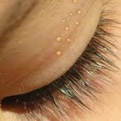 Milia under eyes: Causes, diagnosis, and treatment