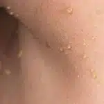 Image of multiple small skin tags on the neck