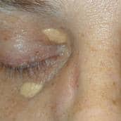 cholesterol bumps on eyelids