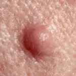 Face mole that can be removed at Thames Valley Surgical Services