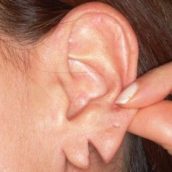 Split Earlobe that can be repaired with Minor Surgery