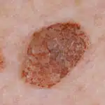 Example of a seborrhoeic keratosis that can easily be removed using Minor Surgery