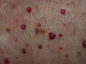 Image of Cherry Angiomas also called Campbell-de-Morgan spots