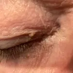 image of a skin tag on the right eyelid