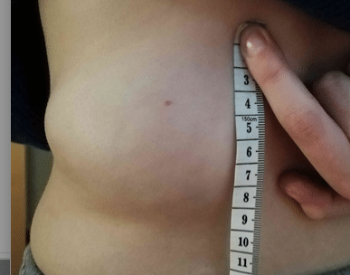 image of a very large Lipoma left lower back