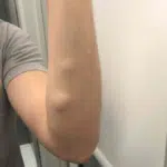 image of 2 lipomas on te left forearm