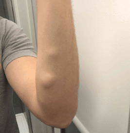 Lipoma Removal Surgery (£250) | Learn more about Lipomas