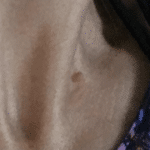 Image of a Skin tag on the neck
