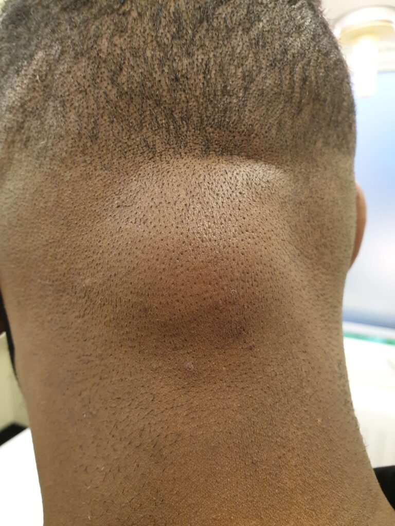 image of a Large Lipoma back of head / neck