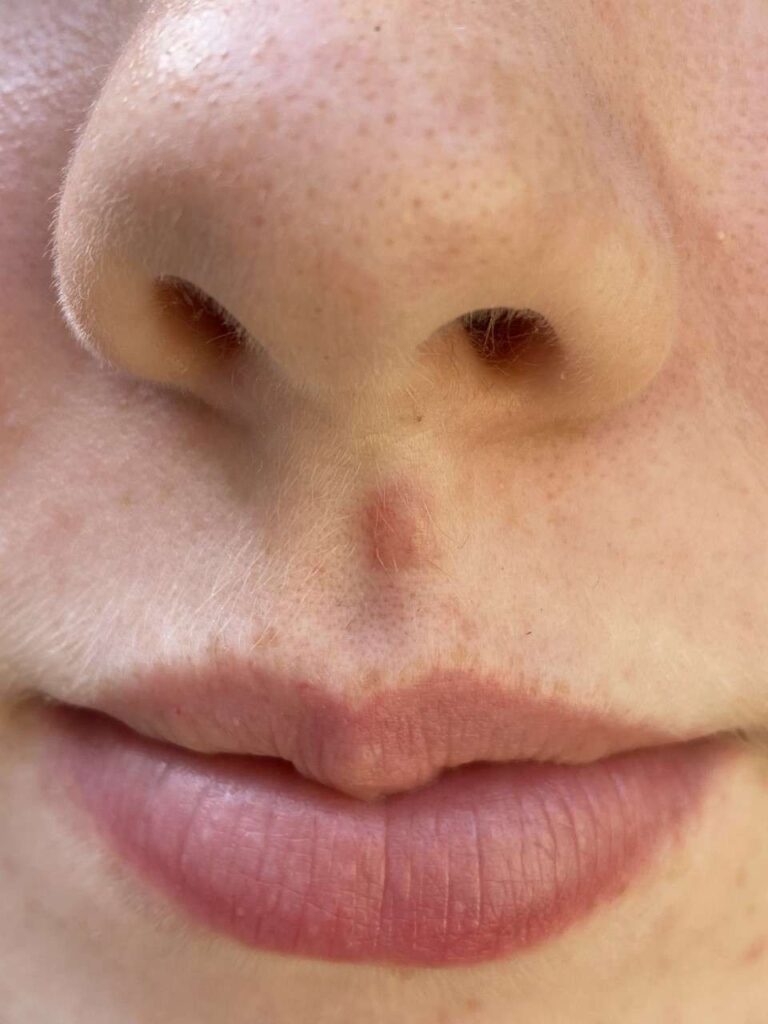 image of the face of a young lady 8 weeks after the removal of a mole above her lip