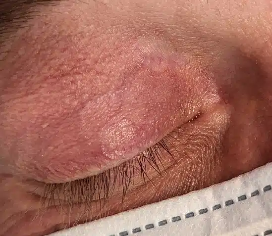 Image of typical Xanthelasma Scar 4 months after Electrodessication Treatment by Dr Kittel