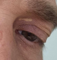 Image of a Xanthelasma on the right upper eyelid