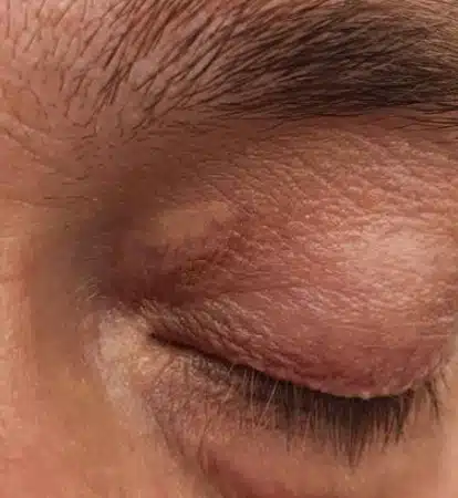 Xanthelasma 4 months after 1st treatment. Not fully resolved