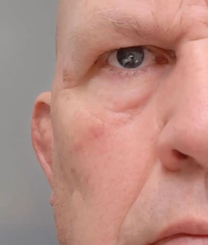 image of a patient after the removal of a warty face mole