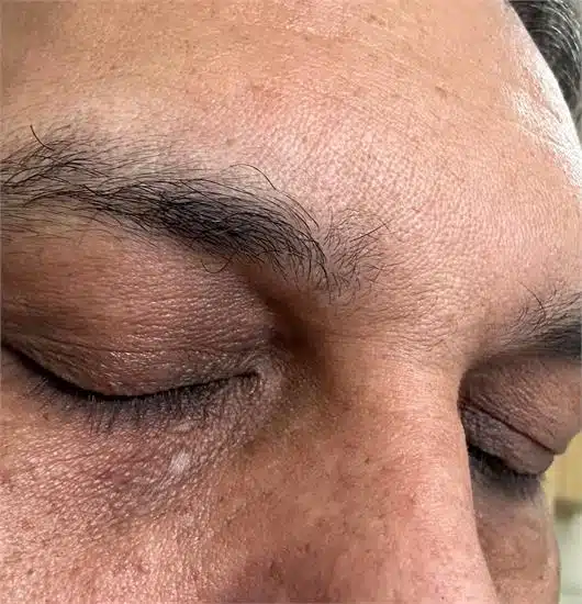 Picture of both upper eyelids in an asian gentleman 4 weeks following excision of 2 Xanthelasmas