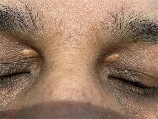 Image of Xanthelasmas both eyelids in an asian gentleman
