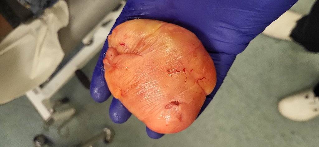 Image of a large Lipoma in the surgeons hand after removal