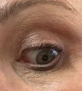 Image of the left eye of a lady after Xanthelasma treatment
