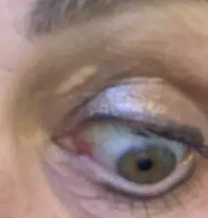 Image of a Xanthelasma left upper eyelid
