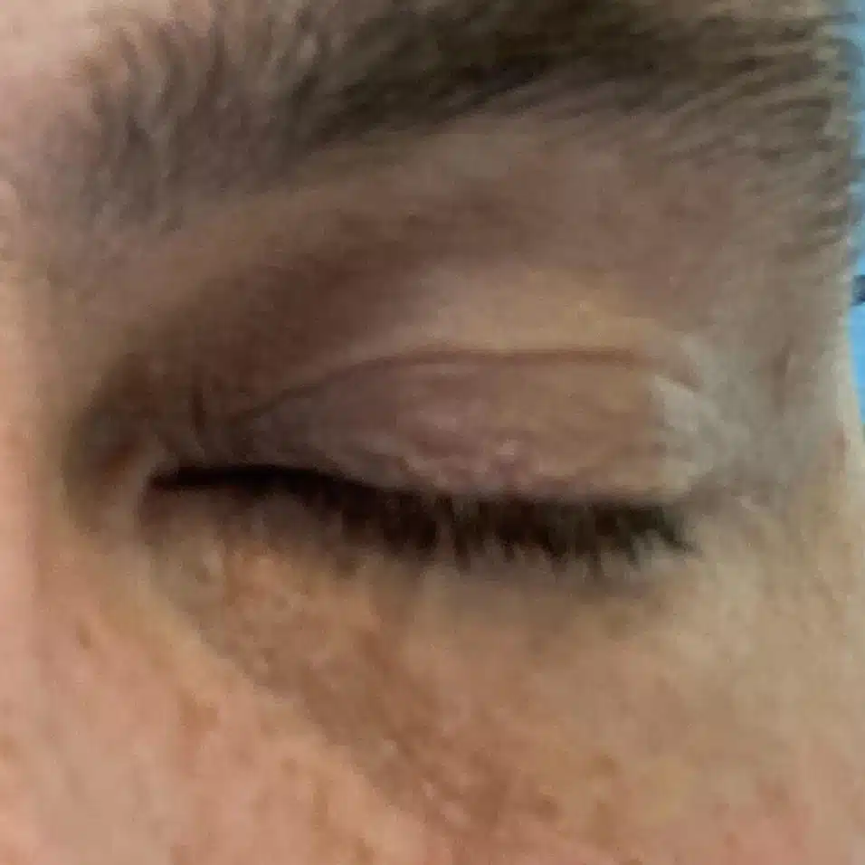 Left eye 3 months after Xanthelasma cut out