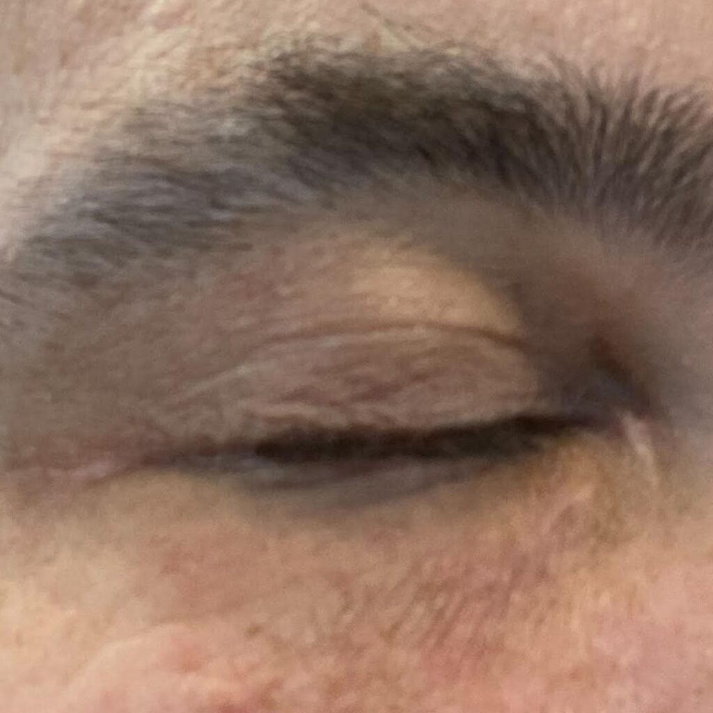 Image of the right eye 3 months after Xanthelasma excision