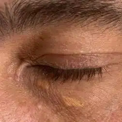 Picture of Xanthelasmas left eye