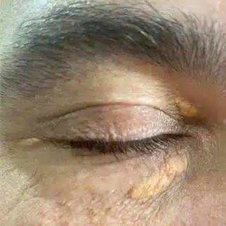 Picture of 3 Xanthelasmas on the right eye