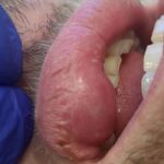 Large Mucocele = Lip cyst = Lip Lump