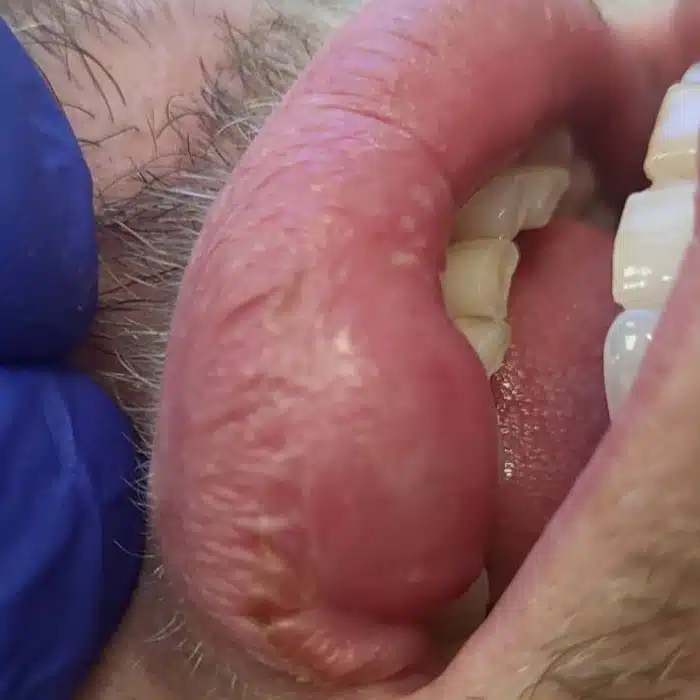 Large Mucocele = Lip cyst = Lip Lump