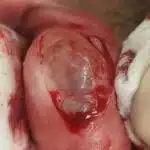 LipCystRemovalSurgery
