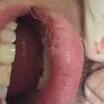 Image of a stitched patients lip after removal of a large cyst