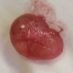 Mucoid cyst