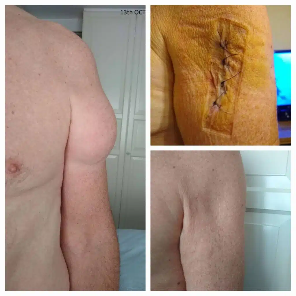 Image Collage of a large Lipoma on the left upper arm before and after surgery and the scar after a year