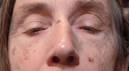 Picture of a gentleman with moles / warts in his face