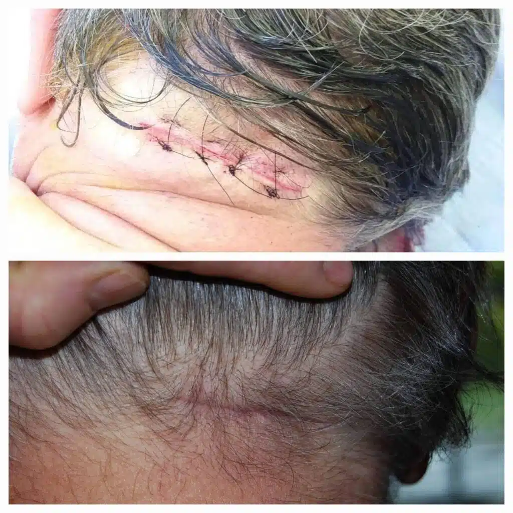 Picture of one of the largest cysts Dr Kittel ever removed.