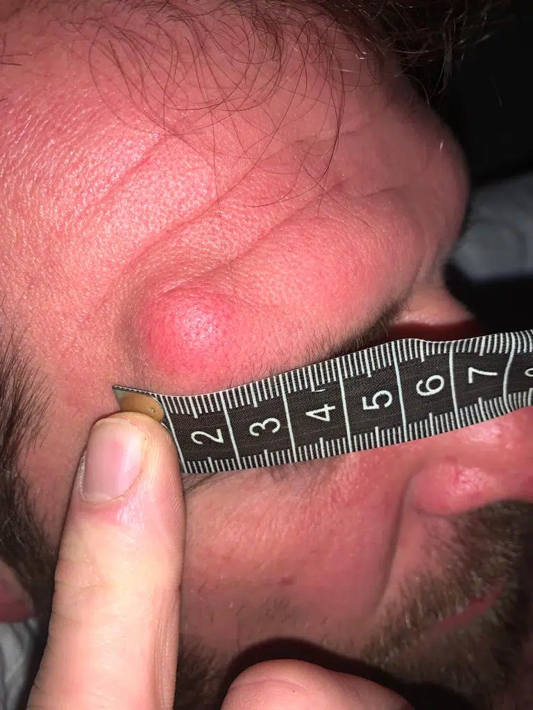 Image of a cyst above the right eyebrow before removal
