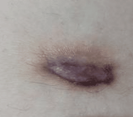 Image of a Dermatofibroma