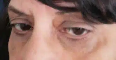 This is an image of the left lower eyelid 2 months after Xanthelasma excision