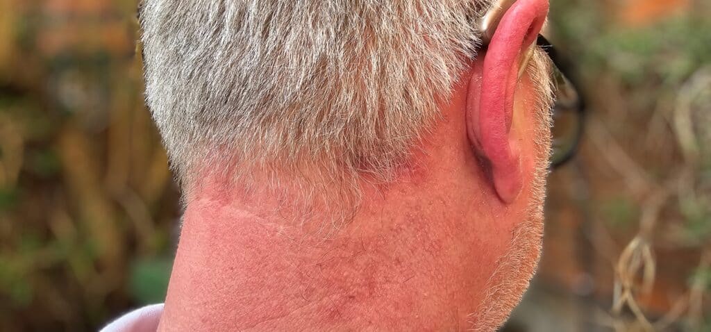 Neck Lipoma 2 months after surgery