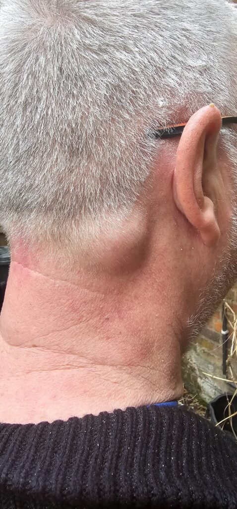 Neck Lipoma before surgery