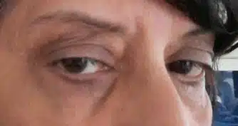 An image of the right lower eyelid 2 months after Xantehlasma excision