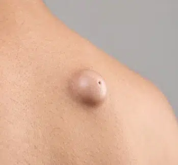picture of a cyst with typical punctum