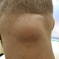 image of a Large Lipoma back of head / neck