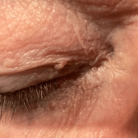 image of a skin tag on the right eyelid