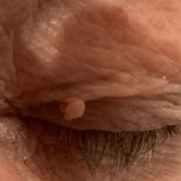 Image of a larger skin tag on the left eyelid that we removed at Thames Valley Surgical Services