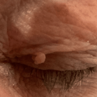 Image of a larger skin tag on the left eyelid that we removed at Thames Valley Surgical Services
